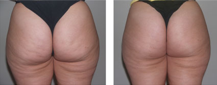 odstran�n� celulitidy